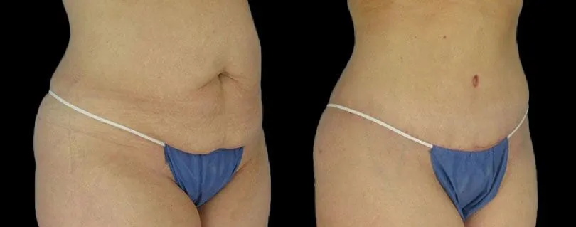 LipoTuck™ Houston and Sugar Land, TX