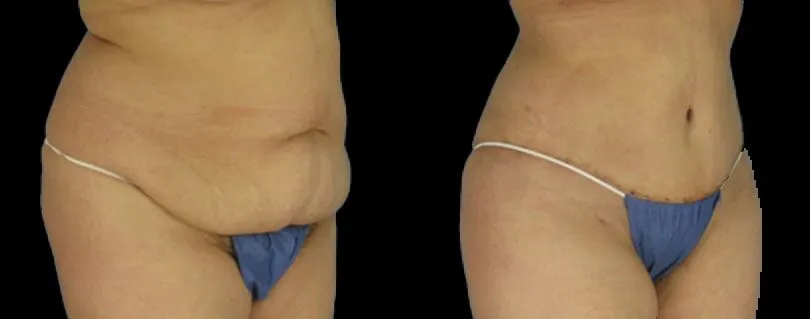 LipoTuck™ Houston and Sugar Land, TX