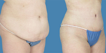 5 Things You Need to Know About Thigh Liposuction - Houston Lipo