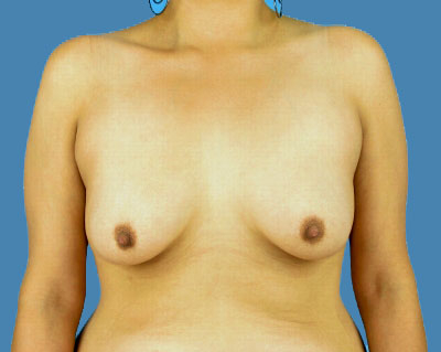Before Breast Augmentation Sugar Land TX