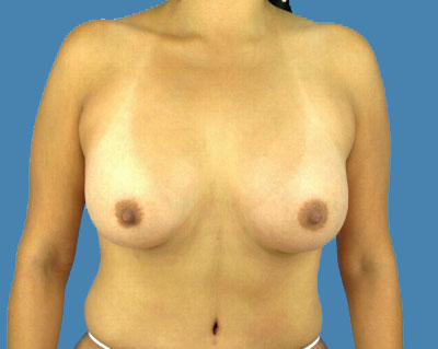 After Breast Augmentation Sugar Land TX