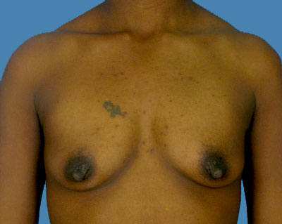 Before Breast Augmentation Surgery Houston TX