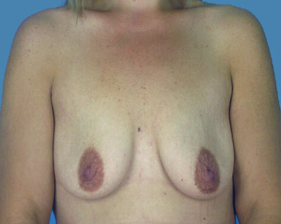 1740676625 breast breast augmentation p57 1 row 1 column 1