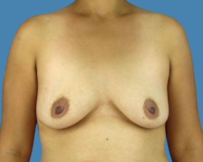 1740676642 breast breast augmentation p55 1 row 1 column 1