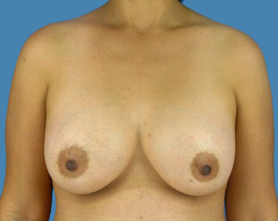 1740676646 breast breast augmentation p55 1 row 1 column 2