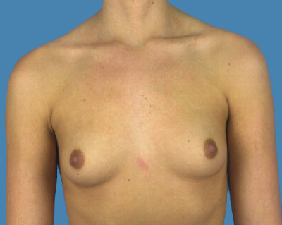 1740676654 breast breast augmentation p53 1 row 1 column 1