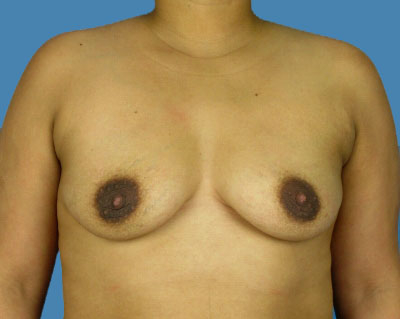 1740676661 breast breast augmentation p52 1 row 1 column 1