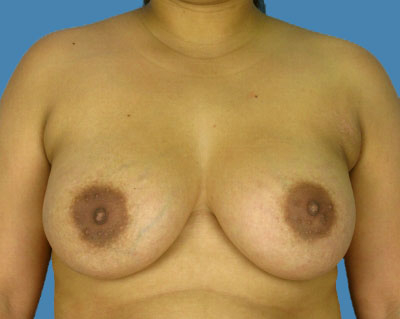 1740676664 breast breast augmentation p52 1 row 1 column 2