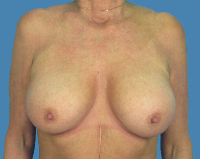 1740676675 breast breast augmentation p51 1 row 1 column 2
