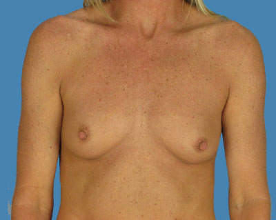 1740676700 breast breast augmentation p47 1 row 1 column 1
