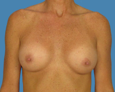 1740676704 breast breast augmentation p47 1 row 1 column 2