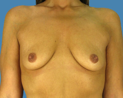 1740676721 breast breast augmentation p42 1 row 1 column 1