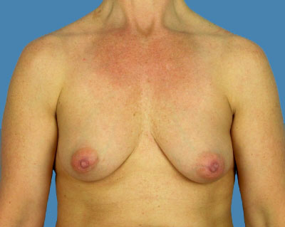 1740676727 breast breast augmentation p41 1 row 1 column 1