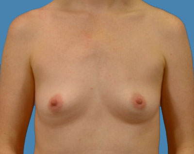 1740676751 breast breast augmentation p36 1 row 1 column 1