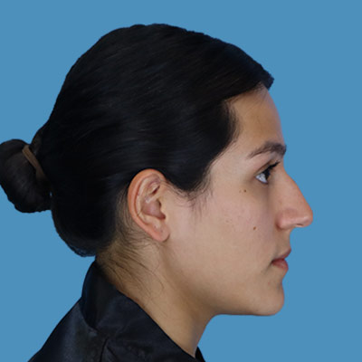 Before Rhinoplasty Houston TX