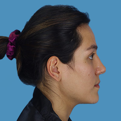 After Rhinoplasty Houston TX