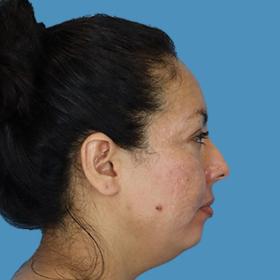 Before Rhinoplasty Treatment Houston TX