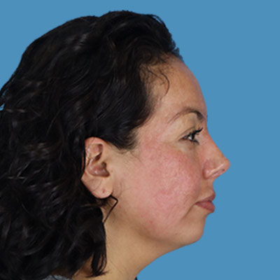 After Rhinoplasty Treatment Houston TX