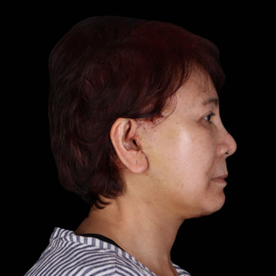 After Necklift Houston TX