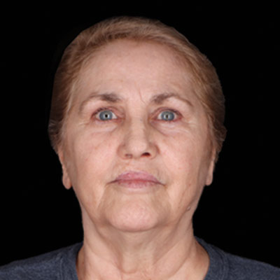 Before Facelift Surgery Houston TX