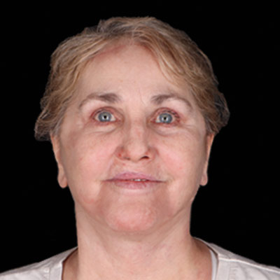 After Facelift Surgery Houston TX