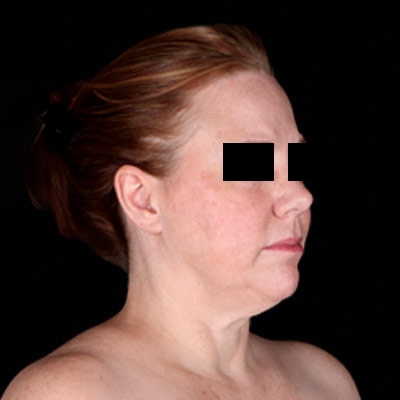 Before Facelift Surgery Sugar Land TX