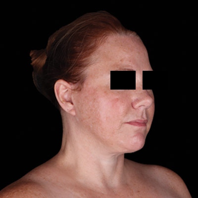 After Facelift Surgery Sugar Land TX
