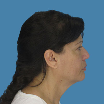 Before Necklift Surgery Houston TX