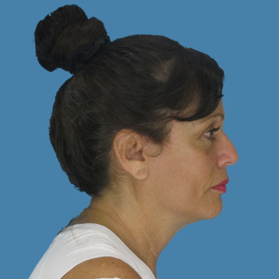 After Necklift Surgery Houston TX