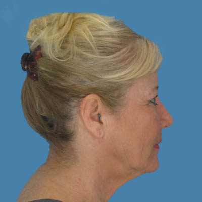 Before Necklift Treatment Houston TX