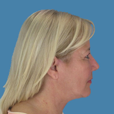 After Necklift Treatment Houston TX