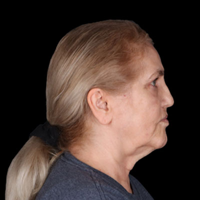 1740676811 Necklift before 318879