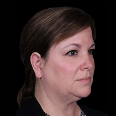 Before Facelift Treatment Houston TX