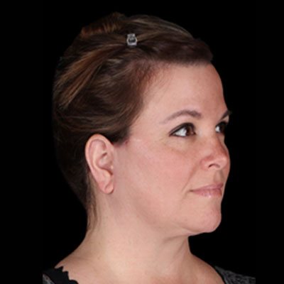 After Facelift Treatment Houston TX