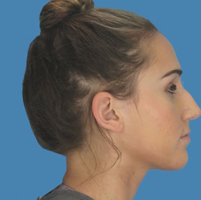 Before Rhinoplasty Sugar Land TX