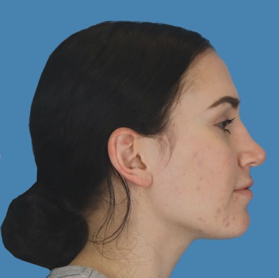 After Rhinoplasty Sugar Land TX