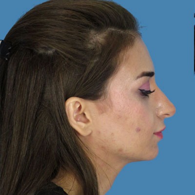 1740676865 face rhinoplasty p2 4 row 1 column 1