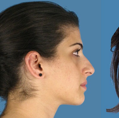 1740676869 face rhinoplasty p3 5 row 1 column 1