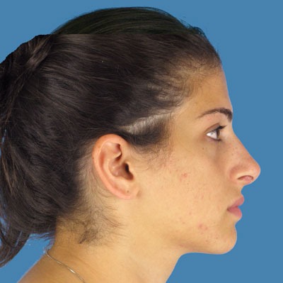 1740676872 face rhinoplasty p3 5 row 1 column 2