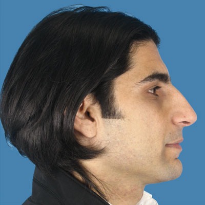 1740676875 face rhinoplasty p4 4 row 1 column 1