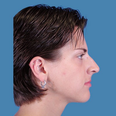 1740676878 face rhinoplasty p5 5 row 1 column 1
