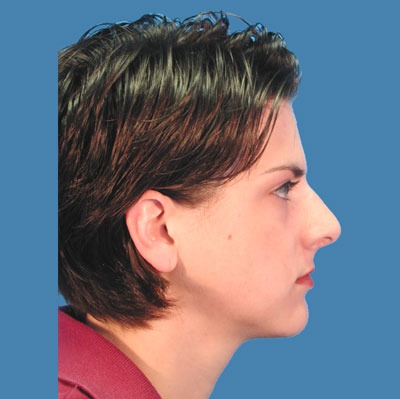 1740676881 face rhinoplasty p5 5 row 1 column 2