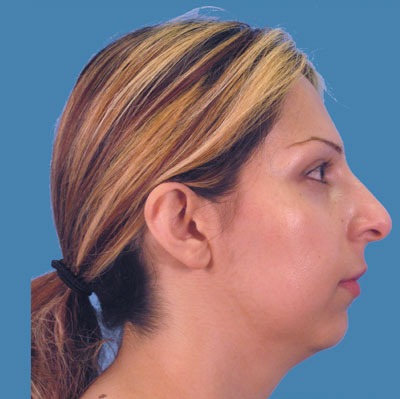 1740676884 face rhinoplasty p6 4 row 1 column 1