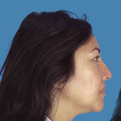 1740676891 face rhinoplasty p7 5 row 1 column 1