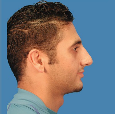 1740676897 face rhinoplasty p8 4 row 1 column 1