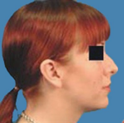 1740676901 face rhinoplasty p9 5 row 1 column 1