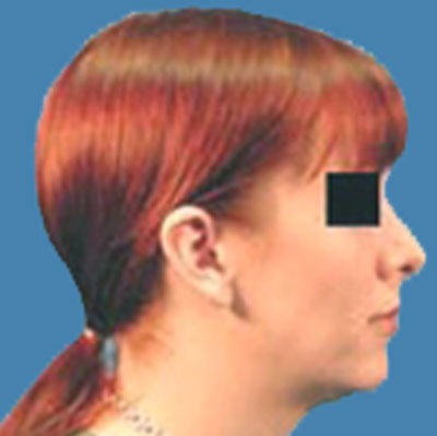 1740676904 face rhinoplasty p9 5 row 1 column 2