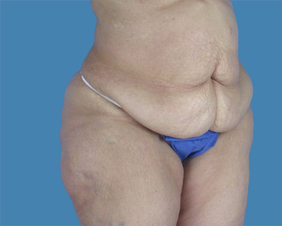 Before Body Contouring Sugar Land TX