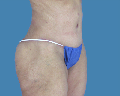 After Body Contouring Sugar Land TX