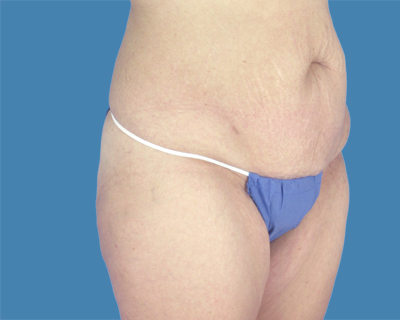 Before Body Lift Treatment Houston TX